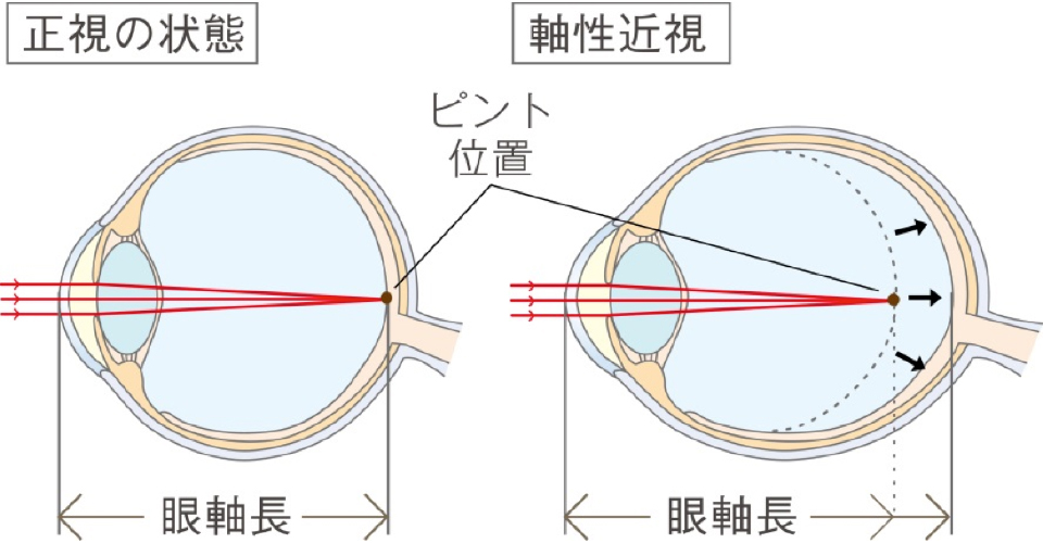 子供の近視 - 正常の状態と軸性近視の比較図